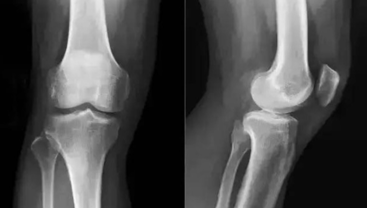 calcitonin salmon application | Shaanxi BLOOM Tech Co., Ltd calcitonin salmon application | Shaanxi BLOOM Tech Co., Ltd