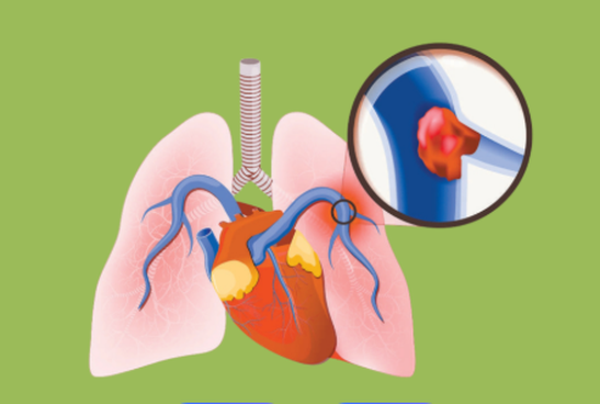 Angiotensin II acetate clinical | Shaanxi BLOOM Tech Co., Ltd Angiotensin II acetate clinical | Shaanxi BLOOM Tech Co., Ltd