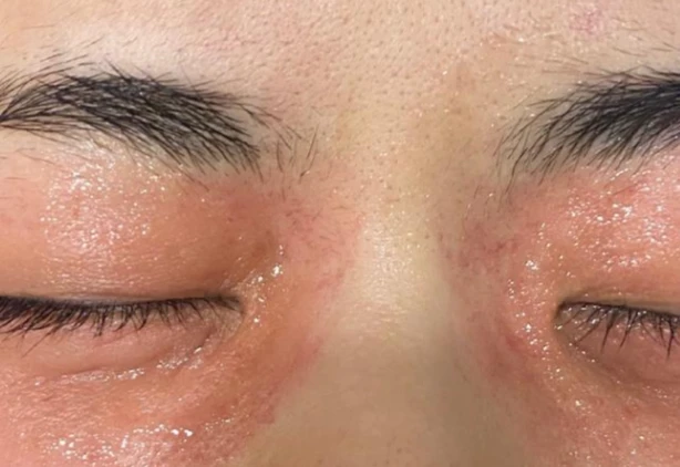 Acetyl Tetrapeptide-5 cutaneous microcirculation | Shaanxi BLOOM Tech Co., Ltd Acetyl Tetrapeptide-5 cutaneous microcirculation | Shaanxi BLOOM Tech Co., Ltd